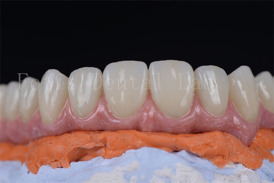 Innovative Minimally Invasive All On 4 All On 6 Dental Implants In 1-2 Weeks