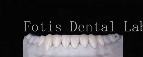 Buy High Durability Natural Looking Teeth Veneers 0.3mm-0.5mm Thickness online manufacture