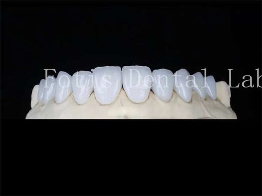 Buy Customized Natural Porcelain Veneers Dental Lab Veneers Stain Resistant online manufacture