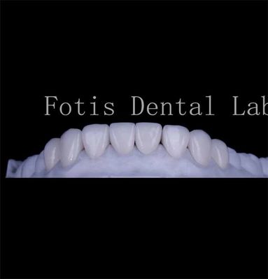 Buy Long Lasting Smooth Texture Teeth Cover Veneers Natural Dental Veneers online manufacture