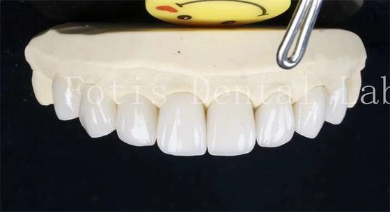 Buy 0.3-0.5mm Ceramic Laminate Teeth False Teeth Veneers With Adhesive Bonding Cement online manufacture