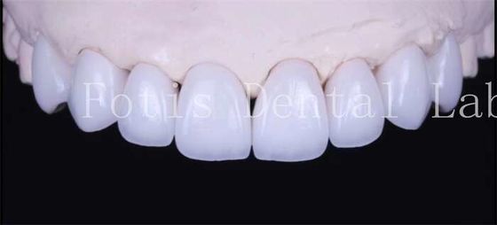 Buy Adhesive Bonding Cement Natural White Veneers With High Translucency online manufacture