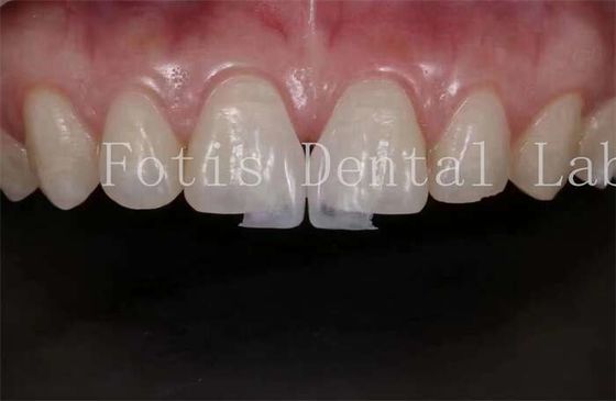 Buy High Translucency Dental Lab Laminate Veneers for Natural and Polishing online manufacture