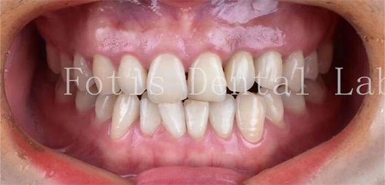 Buy Cosmetic Dentistry Dental Porcelain Veneers With High Stain Resistance online manufacture