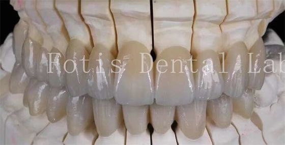 Buy Natural-Looking Smile Prosthetic Porcelain Laminate Veneers Smooth Surface online manufacture