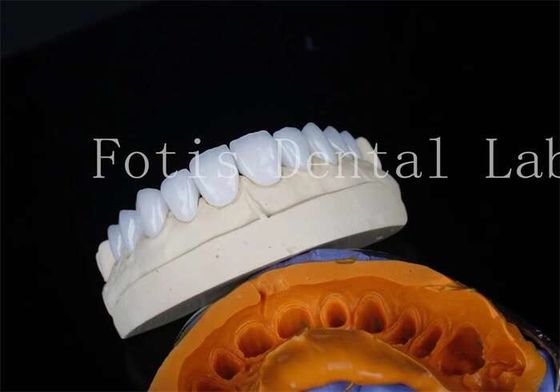 Buy Porcelain Dental Lab Veneers Bonding Cement For Long Lasting Restorations online manufacture