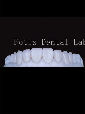 Buy High Translucency Porcelain Tooth Veneers Enhance Your Smile Naturally online manufacture