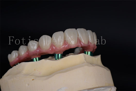 Buy Advanced Full Chewing Ability Restoration Implant Procedure for Low Bone Density Patients online manufacture
