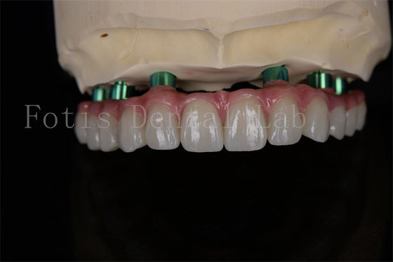 Buy Zirconia All-on-4 Implant Procedure Same Day Recovery Minimal Follow Up Needed online manufacture