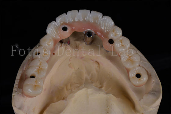 Buy Success Rate All-on-4 Implant Dentures Same Day Procedure Affordable Full Chewing Restoration online manufacture