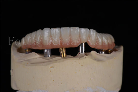 Buy Affordable Natural Looking 4 Or 6 Implants Full Arch Success Rate Minimally Invasive Solution online manufacture