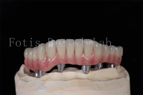 Buy Minimally Invasive Same Day All On 4 All On 6 Implants Natural Looking Easy To Clean online manufacture