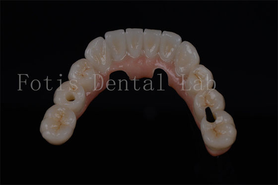 Buy Natural Looking All On Four Teeth In A Day For Any Age Available online manufacture