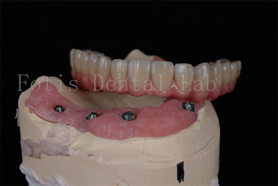Buy Customizable All On 4 All On 6 Dental Implants For Complete Oral Rehabilitation online manufacture