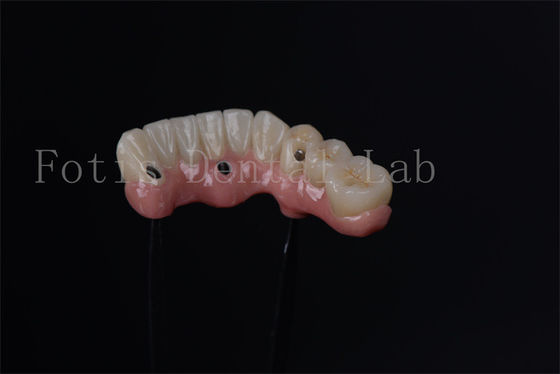 Buy Individual All On 4 All On 6 Endosteal Implants For Immediate Tooth Replacement online manufacture