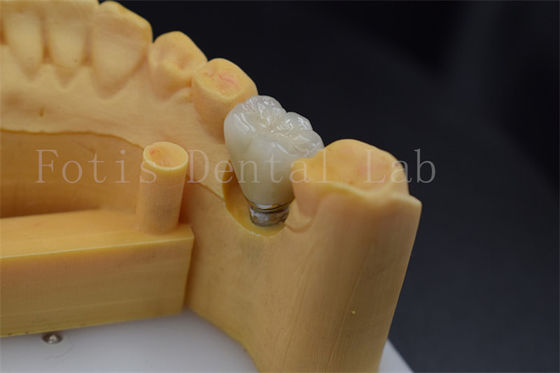 Buy Easy To Place And Adjust Implant Retained Crown Polished Surface Treatment online manufacture