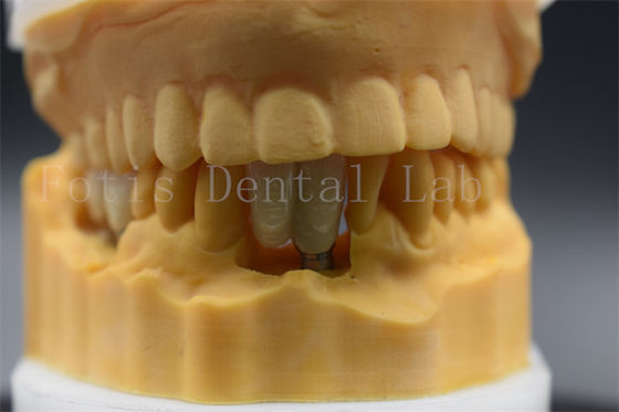 Buy Custom Made Dental Implant Crown Precision Fit For Missing Teeth online manufacture
