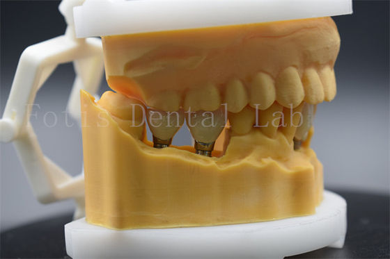 Buy Precision Titanium Dental Crown For Tooth Implant Easy To Clean And Maintain online manufacture