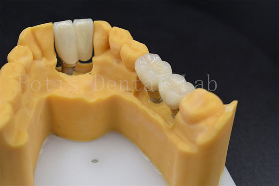 Buy Customizable Dental Restoration Implant Crown Replacement Various Sizes online manufacture