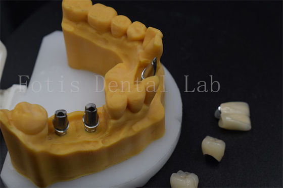 Buy High Durability Tooth Implant Crown Easy To Adjust Dental Implant Guide Sleeves online manufacture