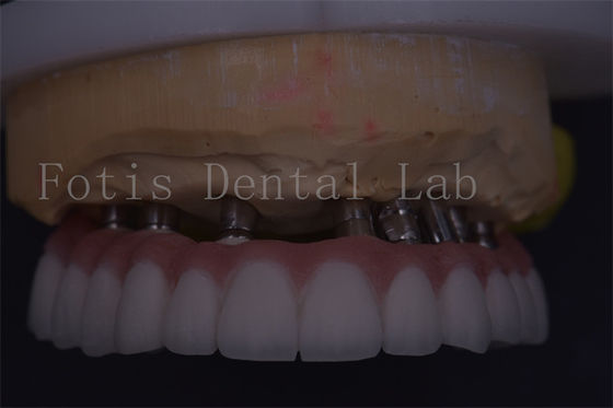 Buy Customizable Silver Dental Crown Precision Fit For Comfortable Restoration online manufacture