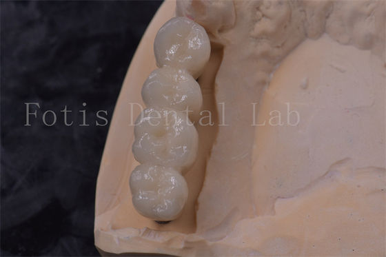 Buy Precision Fit Zirconia Tooth Crown Implant PFM Crown Easy To Clean online manufacture