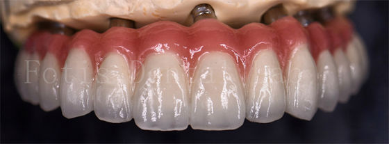 Buy Staining Resistance  Dental Lab Crowns For Various Tooth Replacements online manufacture