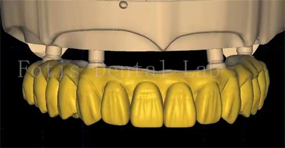 Buy OEM Dental Crown Design Uses Advanced Scanning And 3D Printing Technology online manufacture