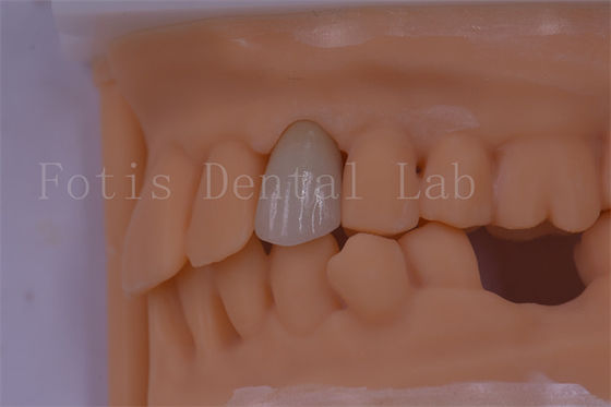 Buy 3 Shape/Exo Design Digital Dental Crowns Better Fit And Less Discomfort online manufacture