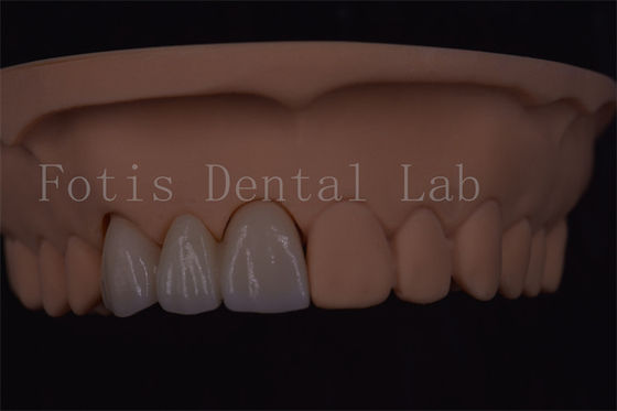 Buy ISO Certified Digital Dental Crowns For Tooth Implant Various Size online manufacture