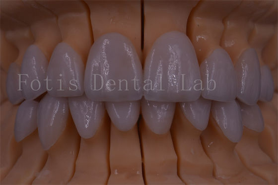 Buy FDA/ISO/CE Certified Digital Crown Teeth Artificial Crown Any Size online manufacture