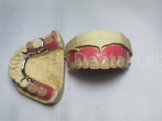 Buy Comfortable Peek Partial Denture / Removable Dental Prosthesis Customized online manufacture