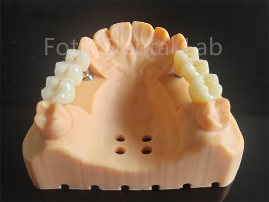 Buy Customized Full Contour Zirconia Layered With Porcelain Dental Material online manufacture