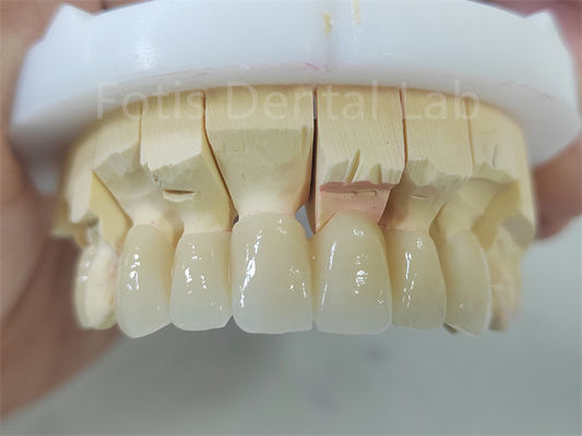 Buy Dental Product Zirconia Layered With Porcelain Easy Maintenance online manufacture