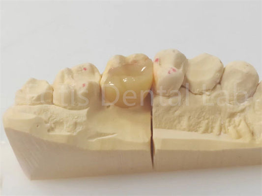 Buy Precision Dental Inlay And Onlay For Accurate And Durable Restorations online manufacture
