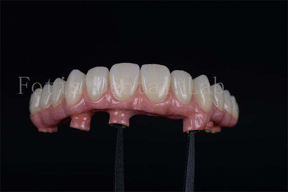 Natural looking Full Chewing Ability Restoration with 4 Or 6 Implants
