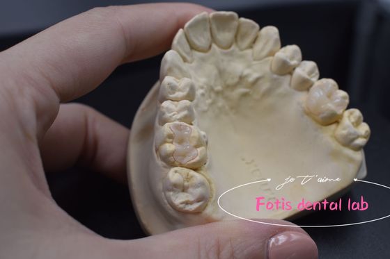 Good price Effective E.Max / Composite Inlays And Onlays For Repair Damaged Or Decayed Teeth online