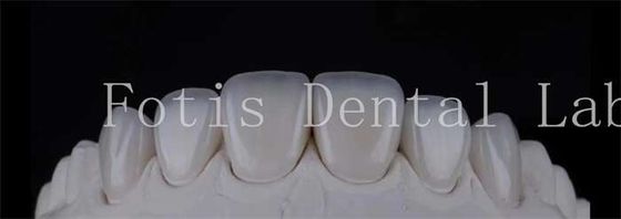 Good price Smooth Polished Ceramic Laminate Veneers In Dentistry Smile Creators online