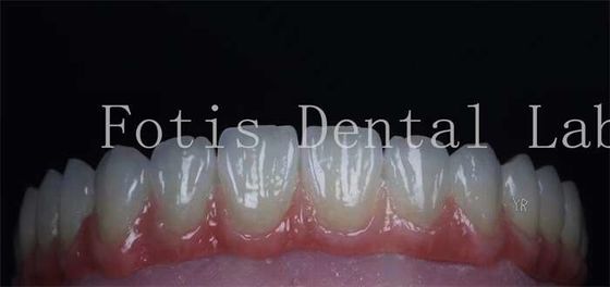 Good price Smooth Surface Cosmetic Tooth Coverings Natural Porcelain Veneers Customizable online