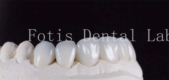 Good price Ultra Strong Translucent Dental Laminate Veneers Natural Color online