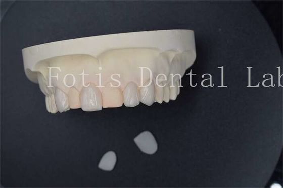 Good price Custom Artificial Dental Lab Veneers With Superior Stain Resistance online