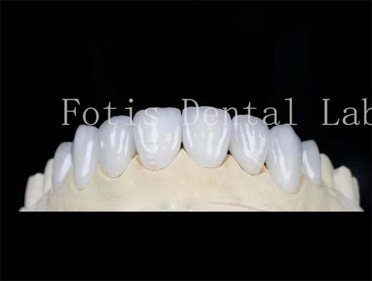 Good price Natural Color Dental Laminate Veneers Fake Teeth Veneers With Bonding Cement online