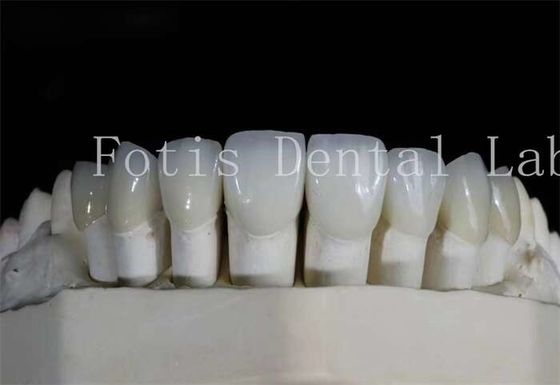 Good price Polished Dental Laminate Veneers High Translucency For Natural Looking Smiles online