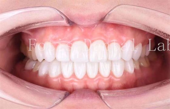 Good price High Translucency Dental Laminate Veneers Long Lasting Durability Polishing Finishing online