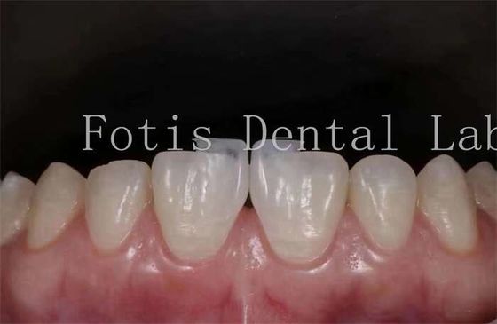 Good price Polishing Synthetic Dental Laminate Veneers High Stain Resistance online