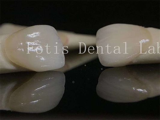Good price Long-lasting Dental Lab Laminate Veneers Customizable for Various Tooth Preparations online