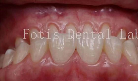 Good price 0.3-0.5mm Thickness Cosmetic Teeth Covers Veneers For Cosmetic Dentistry online