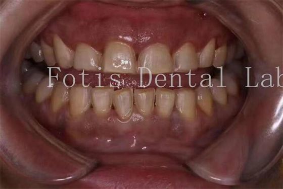 Good price Customization Porcelain Teeth Veneers With Smooth Surface Texture online