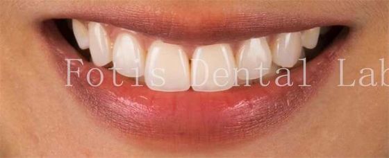Good price High End Cosmetic Teeth Veneers For Perfect Smile Stain Resistance online