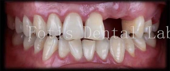 Good price Customised Natural Temporary Dental Veneers For A Beautiful Smile online